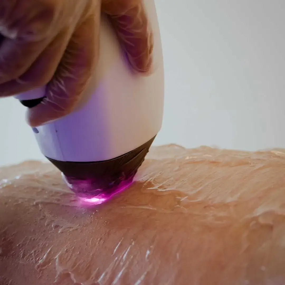 close up aparata epilare definitiva pe piele acasa