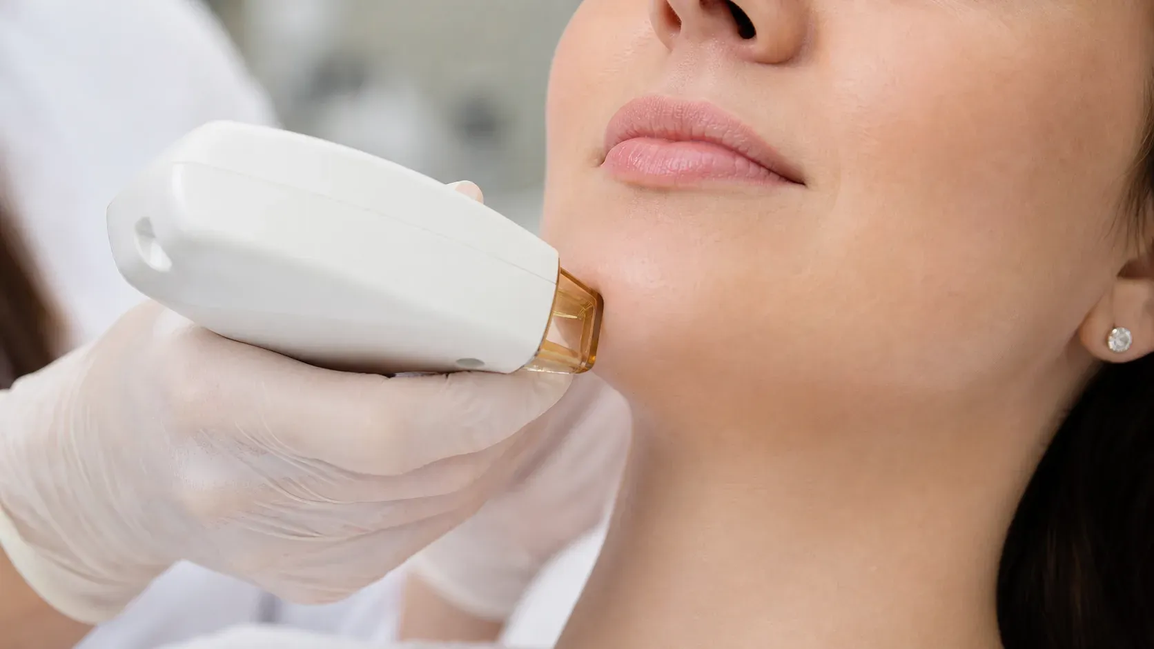 Epilare definitiva barbie - experiența mea cu laser diodă pe firele negre de pe bărbie